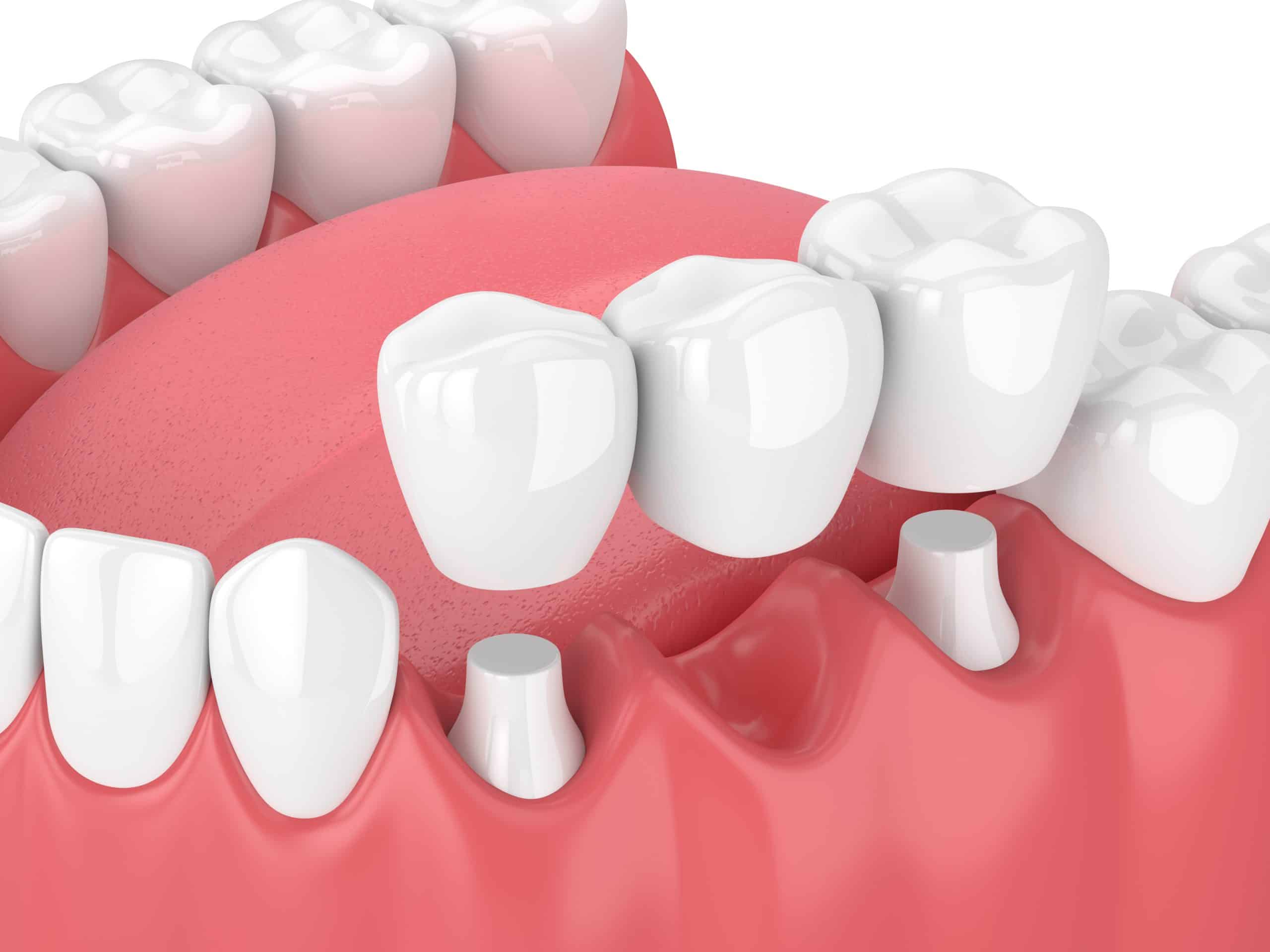 dental bridges taylorsville Dr. Joshua Frandsen DDS Horizon Dental. General, Cosmetic, Restorative, Preventative, Family Dentist Dentistry in Taylorsville, UT 84129