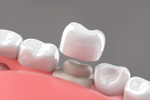 dental crowns taylorsville