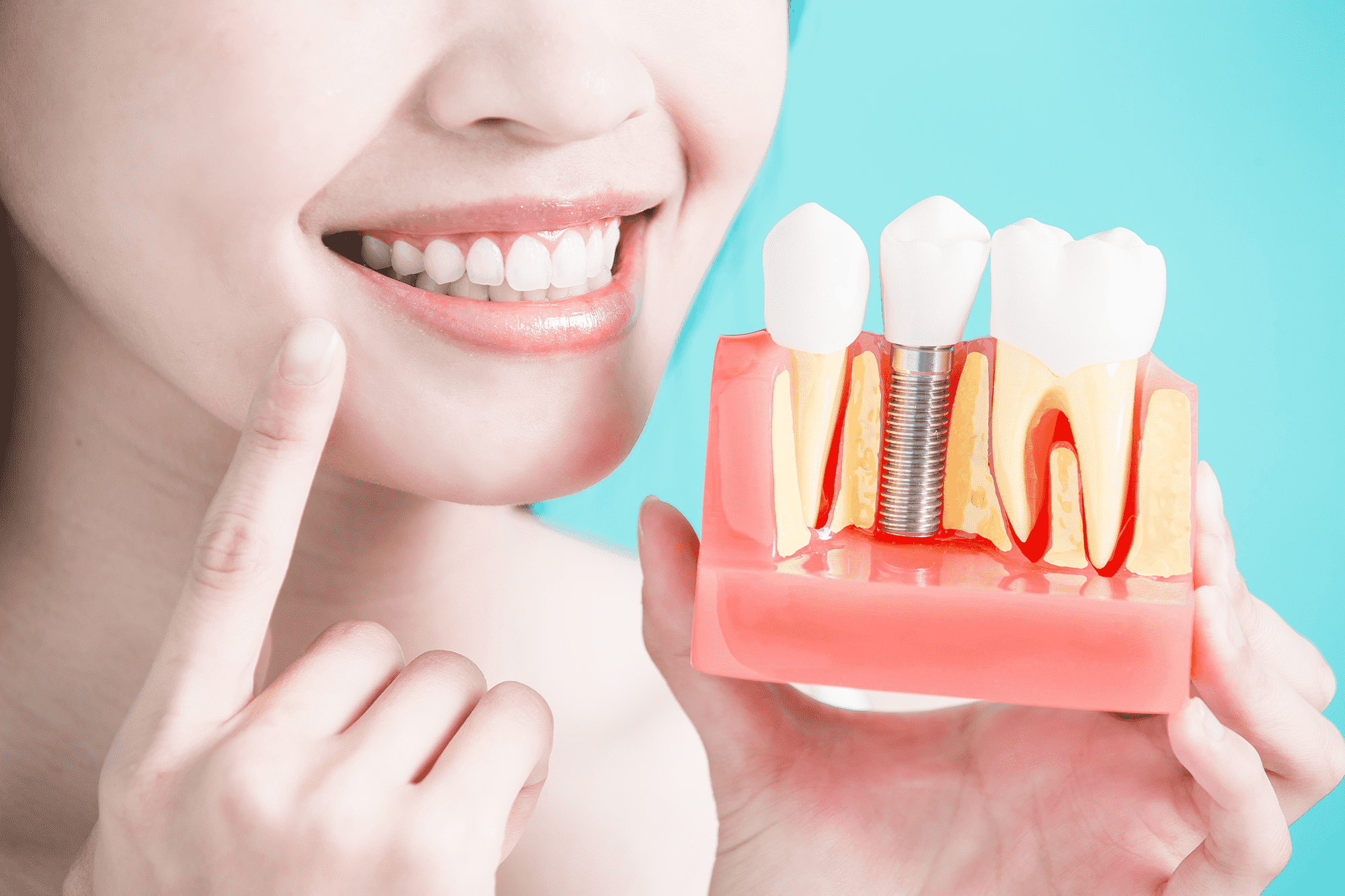 dental implants implant horizon dental dentist in taylorsville utah Dr. Joshua Frandsen dds